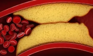 Phát triển thành công loại thuốc mới giúp giảm cholesterol Phát triển thành công loại thuốc mới giúp giảm cholesterol