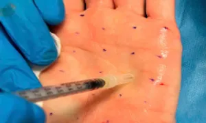 Tiêm botox giảm mồ hôi tay Tiêm botox giảm mồ hôi tay