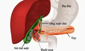 Nguy cơ ung thư đường mật từ những viên sỏi nhỏ