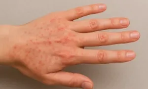 Những bệnh truyền nhiễm dễ bùng phát sau mưa lũ Những bệnh truyền nhiễm dễ bùng phát sau mưa lũ